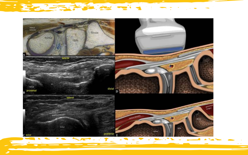Ecografia rodilla lateral 2.png